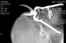 Man survives being impaled on pruning shears… through eye socket