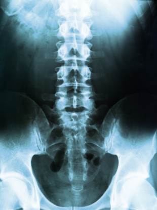 Spinal tap test could detect Parkinson's disease a lot earlier.